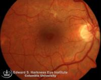 Macular pseudohole and the corresponding OCT study. Note the overlying epiretinal membrane.